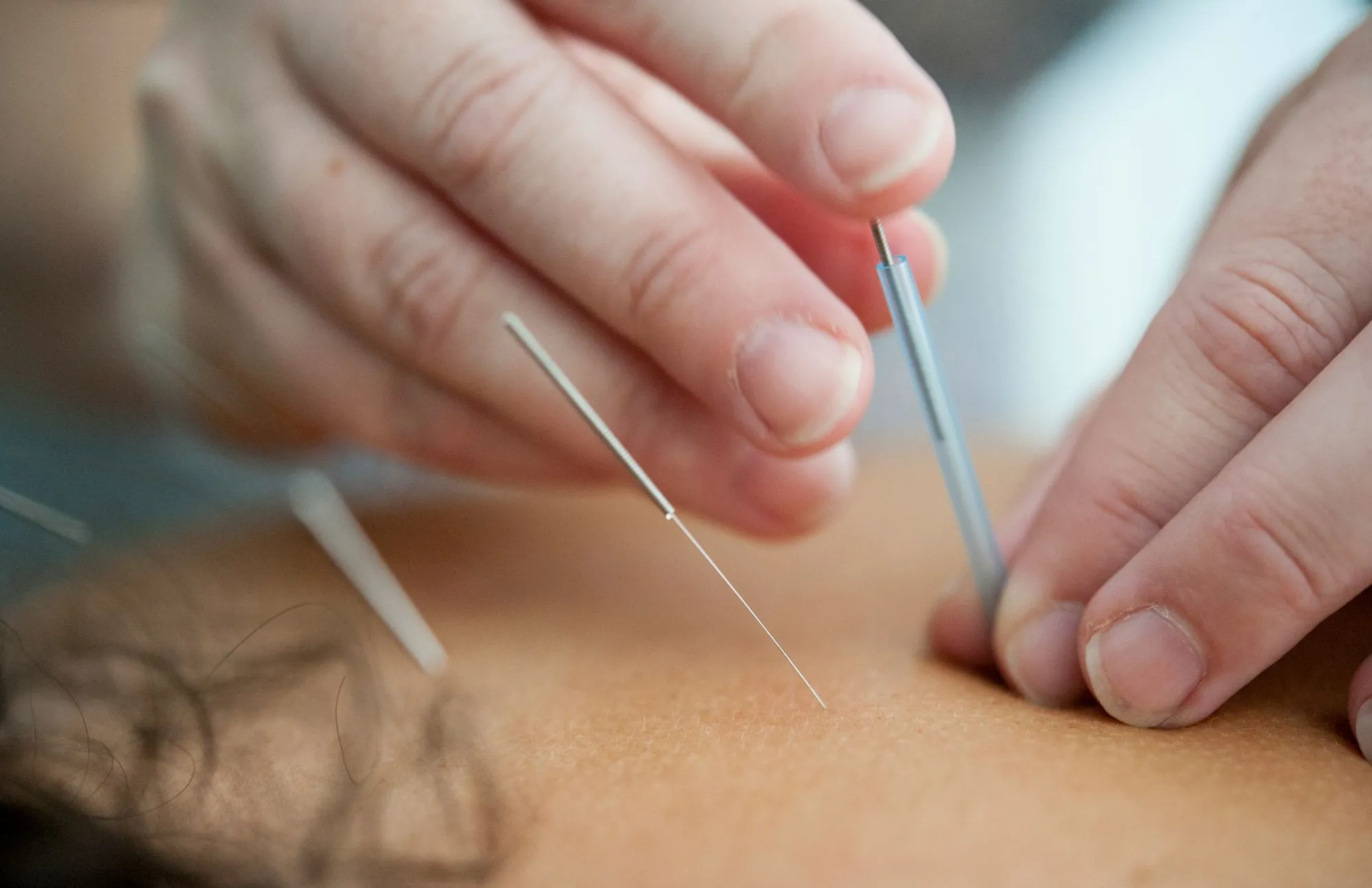 Acupuncture While Pregnant: Reasons to Consider Acupuncture During Pregnancy